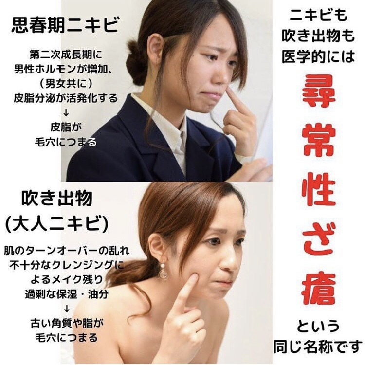 『尋常性ざ瘡』ってなに？