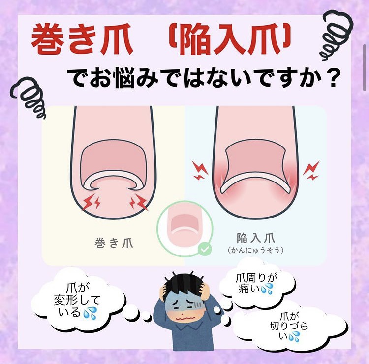 巻き爪（陥入爪）でお悩みではないですか？